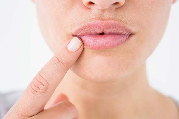 What to do if the corners of your lips are cracked