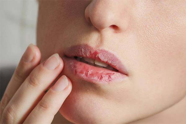 What vitamins are missing if your lips are chapped